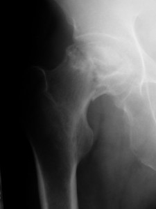 壊死 股関節 大腿骨頭壊死とは。手術によって治るのか？